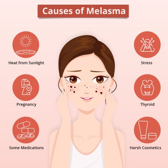 Melasma Treatment in Hyderabad - Causes and Triggers of Melasma: Heat from sunlight, Stress. Pregnancy, Thyroid and Harsh Cosmetics.